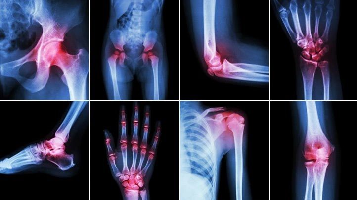 Acupuncture for arthritis